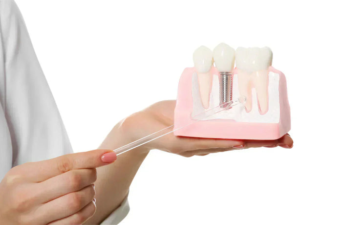 Betændelse i tandimplantat? Sådan passer du på dit nye smil (Peri-implantitis)