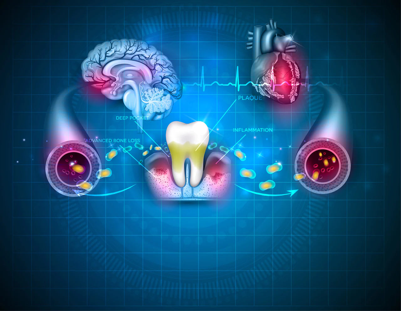 Tandkødsbetændelse kan være en medvirkende årsag til udviklingen af demens