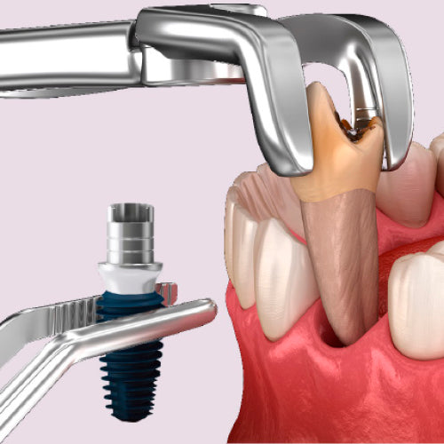 IMPLANTAT: Målrettet implantatbehandling inkl. 70 Lumorinse®